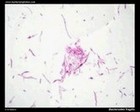 bacteroides fragilis